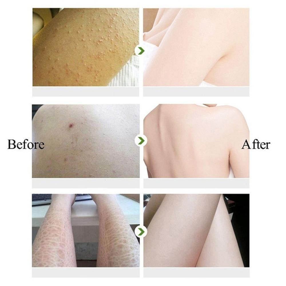 Curing Keratosis Pilaris Chick - Perfume Zara recension och pris