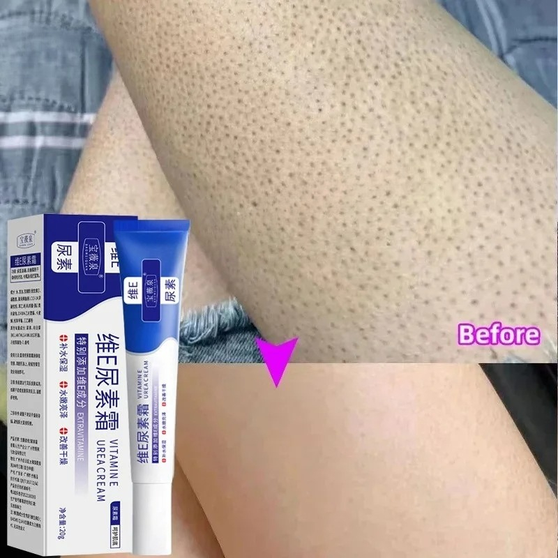 Curing Keratosis Pilaris Chick - Perfume Zara recension och pris