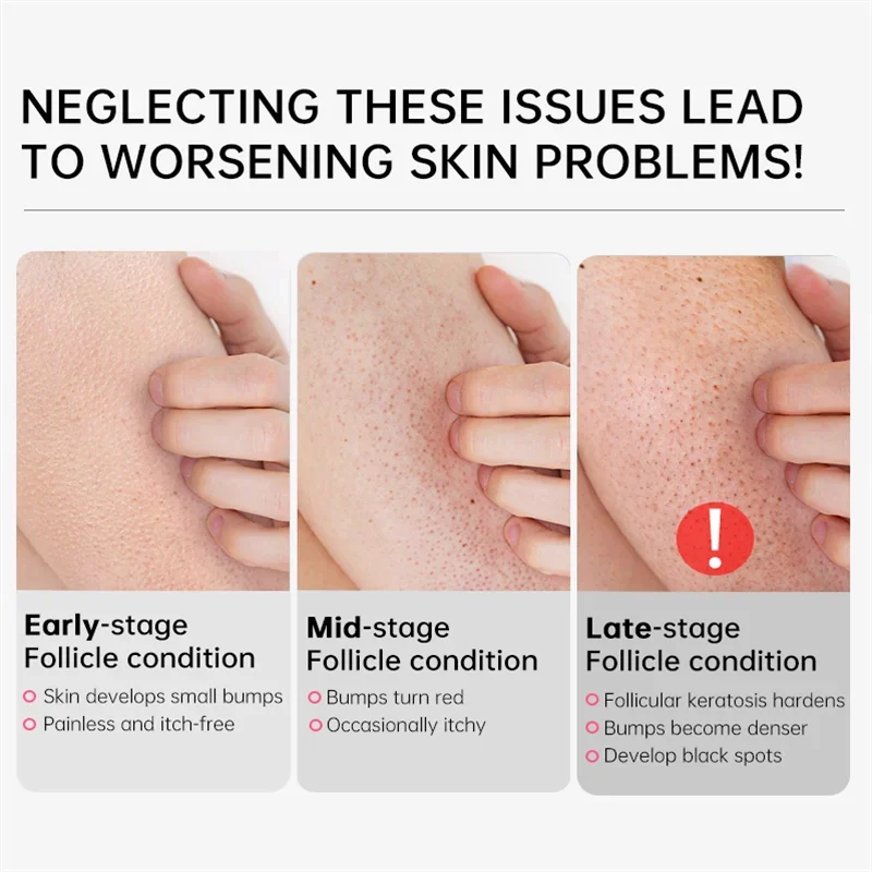 Curing Keratosis Pilaris Chick - Perfume Zara recension och pris